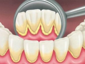 La pulizia dei denti professionale detta anche igiene dentale o detartrasi serve a mantenere sana la dentatura naturale rimuovendo completamente tartaro e placca dentale in modo da prevenire patologie importanti come carie e parodontite (malattia delle gengive); inoltre, una buona igiene è indispensabile a far durare nel tempo il lavoro del dentista evitando di spendere altro denaro per il futuro