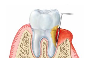 Parodontologia_dentista_paccagnella