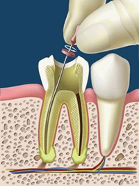 endodonzia-dentista-paccagnella