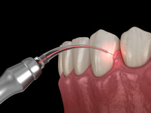 laser dentista paccagnella