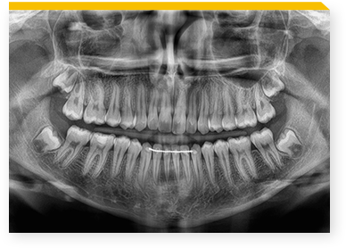 radiografia ai denti ortopantomografia